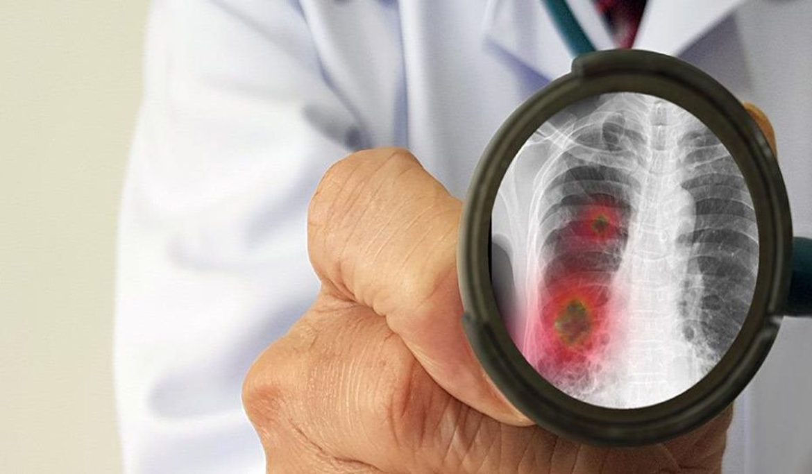 Λιγότεροι αλλά με Σοβαρότερη Νόσο COVID-19 οι Καπνιστές που Καταλήγουν στο Νοσοκομείο.