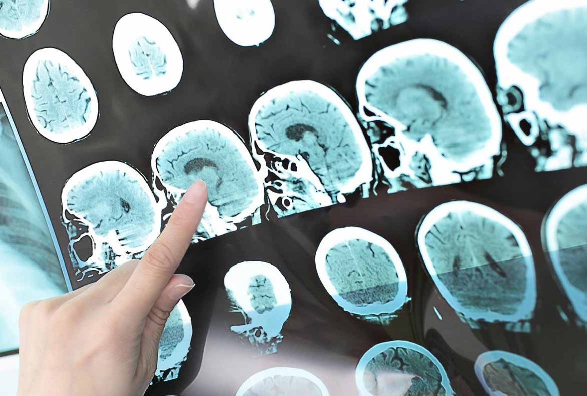 Πολλές Ελπίδες Δίνει Ένα Νέο Φάρμακο Κατά της Πολλαπλής Σκλήρυνσης.