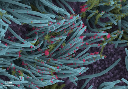 Σε έγχρωμη απόδοση η εικόνα δείχνει τα ανθρώπινα κύτταρα που είναι μολυσμένα με τον SARS-CoV-2 (μωβ) καλυμμένα με κροσσούς (μπλε).