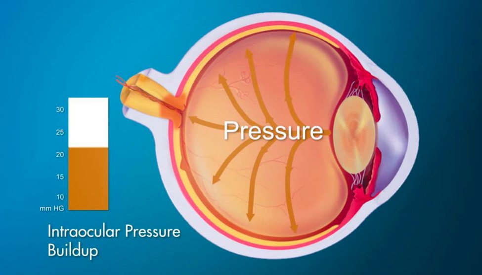 Η φυσιολογική πίεση των ματιών αλλάζει κατά τη διάρκεια της ημέρας και κυμαίνεται συνήθως μεταξύ 10 και 21 mmHG (χιλιοστά στήλης υδραργύρου).