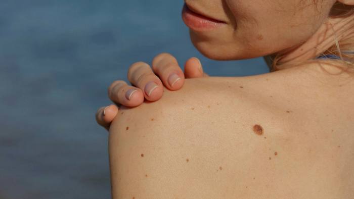 Νέο Έξυπνο Εργαλείο της Google Εντοπίζει τις Δερματικές Παθήσεις.