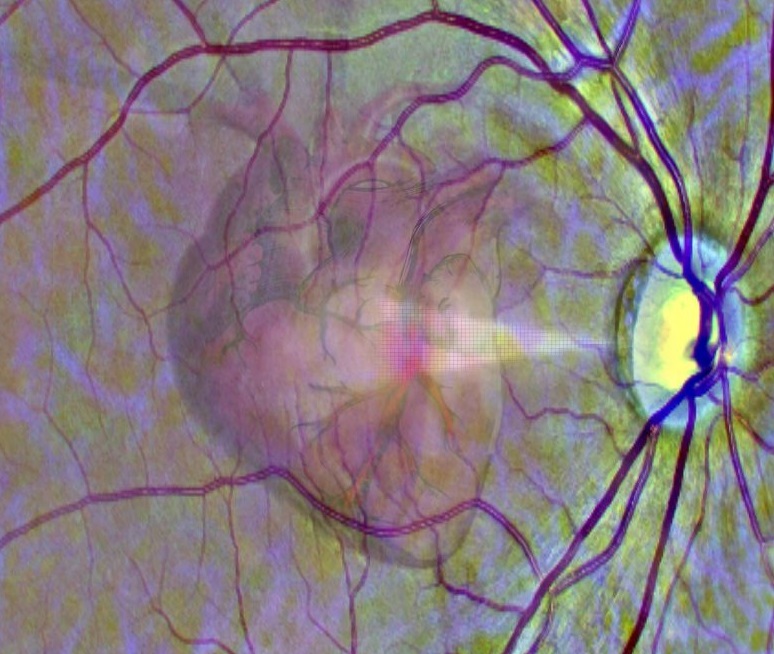Το Πρώτο Σύστημα Τεχνητής Νοημοσύνης που Διαβάζει στα Μάτια τον Κίνδυνο Εμφράγματος.