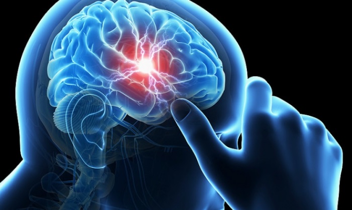 Υψηλότερος ο Κίνδυνος Αγγειακού Εγκεφαλικού Επεισοδίου Αμέσως Μετά από COVID-19.