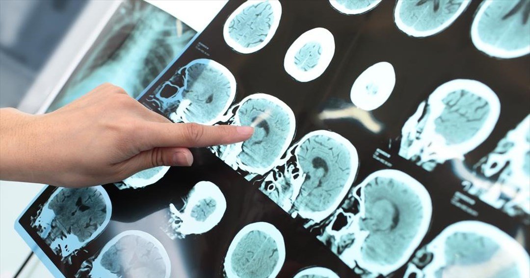 Κατευθυντήριες Οδηγίες για την Αντιμετώπιση των Εγκεφαλικών Επεισοδίων.