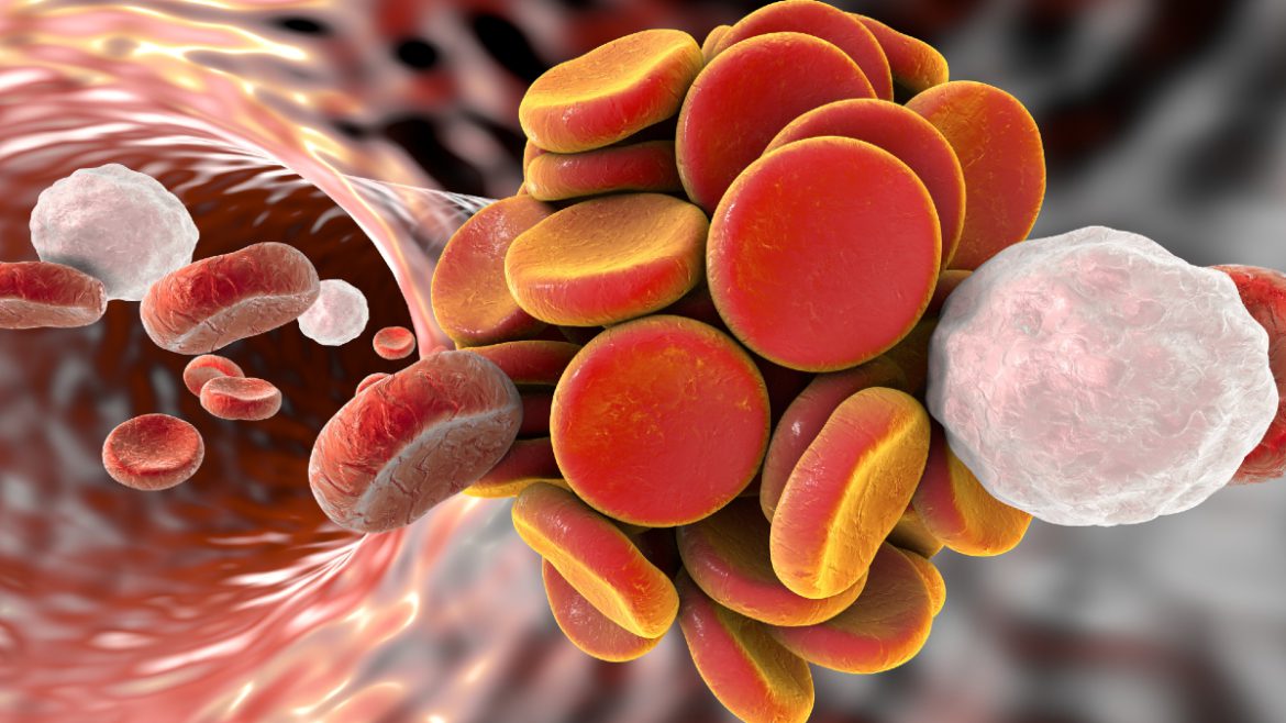 Η Φλεβική Θρομβοεμβολή Είναι η Κύρια Αιτία Ενδονοσοκομειακών Θανάτων. Η Φλεβική Θρομβοεμβολή Είναι η Κύρια Αιτία Ενδονοσοκομειακών Θανάτων.