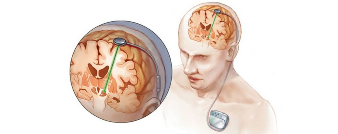 Νέα τεχνική βαθιάς διέγερσης εγκεφαλικών νευρωνικών δικτύων για θεραπεία γνωστικών διαταραχών σε ασθενείς έπειτα από τραυματική εγκεφαλική βλάβη