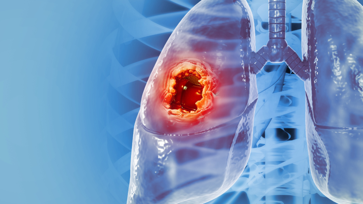 καρκίνος του πνεύμονα